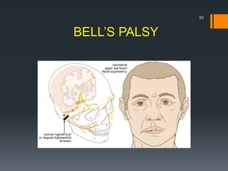 BELL’S PALSY
53
 