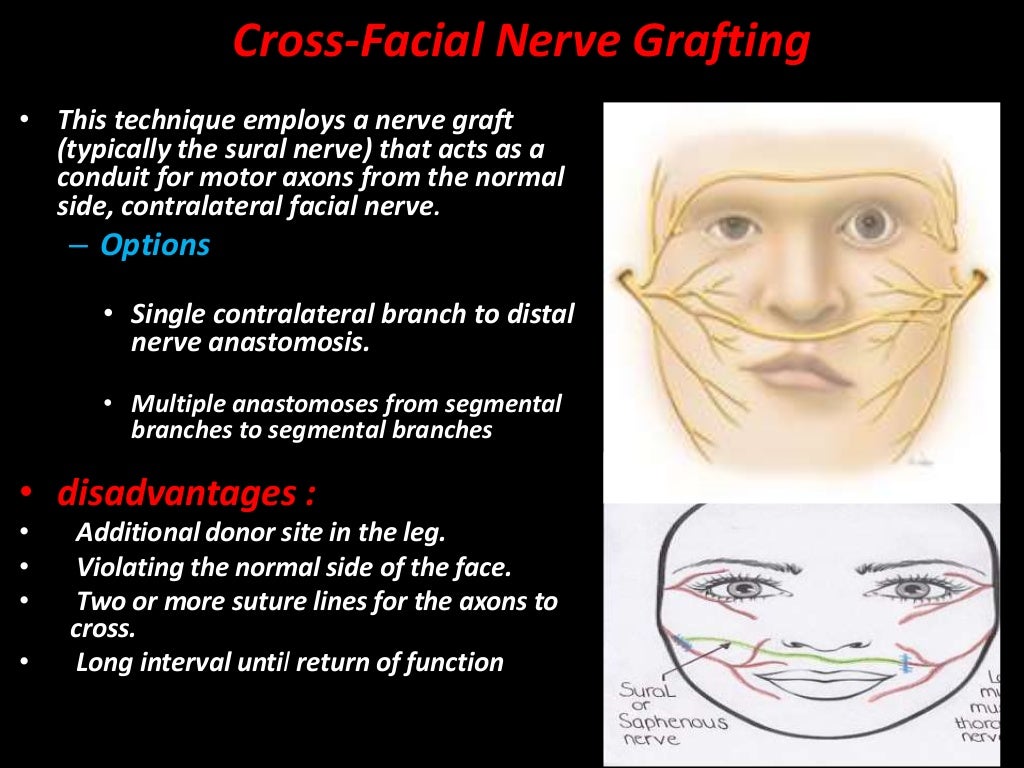Facial nerve injury and reanimation