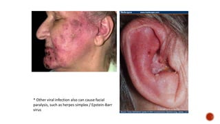 * Other viral infection also can cause facial
paralysis, such as herpes simplex / Epstein-Barr
virus
 