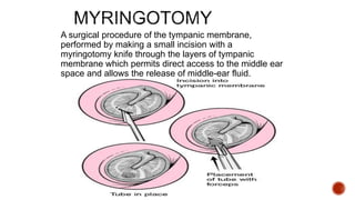 A surgical procedure of the tympanic membrane,
performed by making a small incision with a
myringotomy knife through the layers of tympanic
membrane which permits direct access to the middle ear
space and allows the release of middle-ear fluid.
 