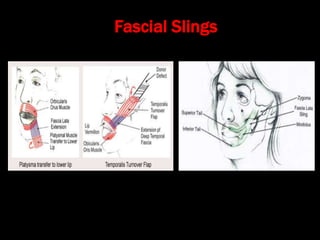 Fascial Slings
 