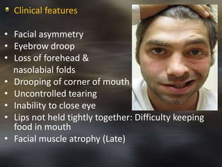 Clinical features 
• Facial asymmetry 
• Eyebrow droop 
• Loss of forehead & 
nasolabial folds 
• Drooping of corner of mouth 
• Uncontrolled tearing 
• Inability to close eye 
• Lips not held tightly together: Difficulty keeping 
food in mouth 
• Facial muscle atrophy (Late) 
 