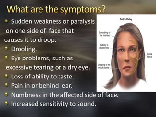 Sudden weakness or paralysis 
on one side of face that 
causes it to droop. 
Drooling. 
Eye problems, such as 
excessive tearing or a dry eye. 
Loss of ability to taste. 
Pain in or behind ear. 
Numbness in the affected side of face. 
Increased sensitivity to sound. 
 