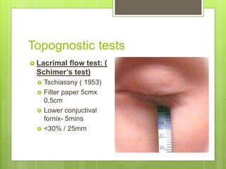 Topognostic tests
 Lacrimal flow test: (
Schimer’s test)
 Tschiassny ( 1953)
 Filter paper 5cmx
0.5cm
 Lower conjuctival
fornix- 5mins
 <30% / 25mm
 