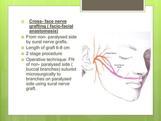 2) Cross- face nerve
grafting ( facio-facial
anastomosis)
 From non- paralysed side
by sural nerve grafts.
 Length of graft 6-8 cm
 2 stage procedure
 Operative technique: FN
of non- paralysed side (
buccal branches) sutured
microsurgically to
branches on paralysed
side using sural nerve
graft.
 