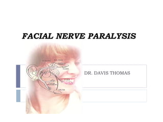 FACIAL NERVE PARALYSIS
DR. DAVIS THOMAS
 