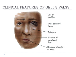 CLINICAL FEATURES OF BELL’S PALSY
 