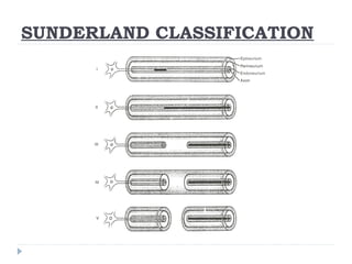 SUNDERLAND CLASSIFICATION
 