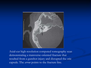 Axial-cut high-resolution computed tomography scan
demonstrating a transverse-oriented fracture that
resulted from a gunshot injury and disrupted the otic
capsule. The arrow points to the fracture line.
 