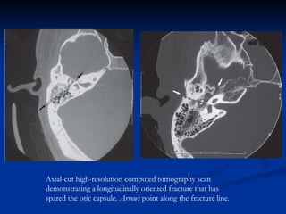 Axial-cut high-resolution computed tomography scan
demonstrating a longitudinally oriented fracture that has
spared the otic capsule. Arrows point along the fracture line.
 