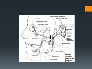 Lesion
distal to
geniculate
ganglion

 