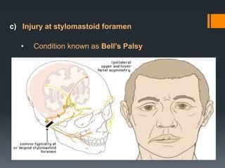 c) Injury at stylomastoid foramen
•

Condition known as Bell’s Palsy

 