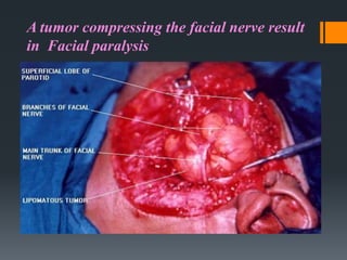 A tumor compressing the facial nerve result
in Facial paralysis

 