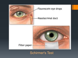 Schirmer's Test

 