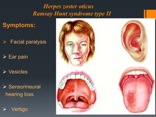 Herpes zoster oticus
Ramsay Hunt syndrome type II
Symptoms:
 Facial paralysis
 Ear pain
 Vesicles
 Sensorineural
hearing loss
 Vertigo

 