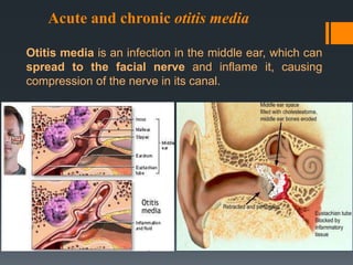 Acute and chronic otitis media
Otitis media is an infection in the middle ear, which can
spread to the facial nerve and inflame it, causing
compression of the nerve in its canal.

 