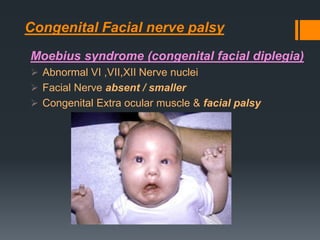 Congenital Facial nerve palsy
Moebius syndrome (congenital facial diplegia)
 Abnormal VI ,VII,XII Nerve nuclei
 Facial Nerve absent / smaller
 Congenital Extra ocular muscle & facial palsy

 