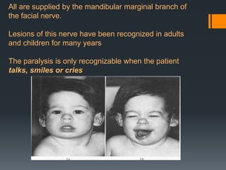 All are supplied by the mandibular marginal branch of
the facial nerve.
Lesions of this nerve have been recognized in adults
and children for many years

The paralysis is only recognizable when the patient
talks, smiles or cries

 