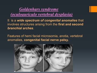 Goldenhars syndrome
(oculoauriculo vertebral dysplasia)
It is a wide spectrum of congenital anomalies that
involves structures arising from the first and second
branchial arches.
Features of hemi facial microsomia, anotia, vertebral
anomalies, congenital facial nerve palsy.

 