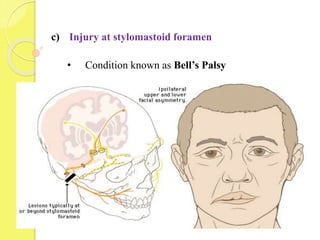 c) Injury at stylomastoid foramen
• Condition known as Bell’s Palsy
 