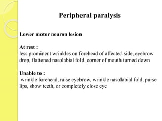 Peripheral paralysis
Lower motor neuron lesion
At rest :
less prominent wrinkles on forehead of affected side, eyebrow
drop, flattened nasolabial fold, corner of mouth turned down
Unable to :
wrinkle forehead, raise eyebrow, wrinkle nasolabial fold, purse
lips, show teeth, or completely close eye
 