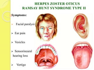 Symptoms:
 Facial paralysis
 Ear pain
 Vesicles
 Sensorineural
hearing loss
 Vertigo
HERPES ZOSTER OTICUS
RAMSAY HUNT SYNDROME TYPE II
 