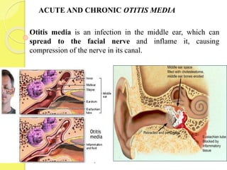 ACUTE AND CHRONIC OTITIS MEDIA
Otitis media is an infection in the middle ear, which can
spread to the facial nerve and inflame it, causing
compression of the nerve in its canal.
 