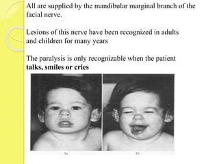 All are supplied by the mandibular marginal branch of the
facial nerve.
Lesions of this nerve have been recognized in adults
and children for many years
The paralysis is only recognizable when the patient
talks, smiles or cries
 