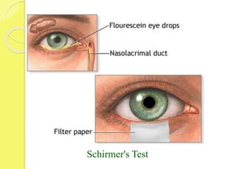 Schirmer's Test
 