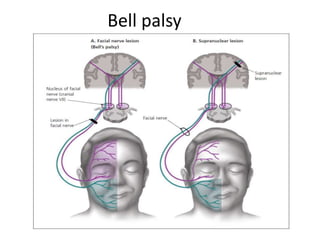 Bell palsy
 