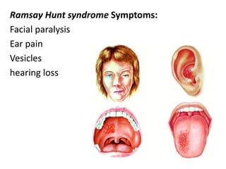 Ramsay Hunt syndrome Symptoms:
Facial paralysis
Ear pain
Vesicles
hearing loss
 