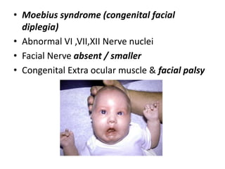 • Moebius syndrome (congenital facial
diplegia)
• Abnormal VI ,VII,XII Nerve nuclei
• Facial Nerve absent / smaller
• Congenital Extra ocular muscle & facial palsy
 