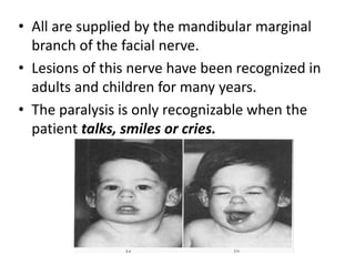 • All are supplied by the mandibular marginal
branch of the facial nerve.
• Lesions of this nerve have been recognized in
adults and children for many years.
• The paralysis is only recognizable when the
patient talks, smiles or cries.
 
