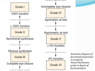 Schematic diagram of
functional progression
in assigning
House-Brackmann
grade to degree of
facial paralysis.
 