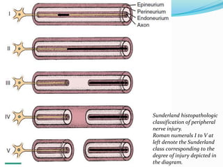 Sunderland histopathologic
classification of peripheral
nerve injury.
Roman numerals I to V at
left denote the Sunderland
class corresponding to the
degree of injury depicted in
the diagram.
 