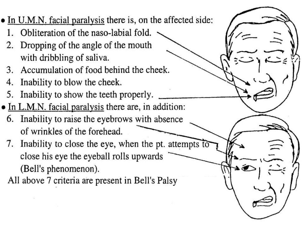 Facial Nerve Palsy Types