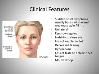 Clinical Features
• Sudden onset symptoms,
usually hours w/ maximal
weakness w/in 48 hrs
• Unilateral
• Eyebrow sagging
• Inability to close eye
• Loss of nasolabial fold
• Decreased tearing
• Hyperacusis
• Loss of taste to anterior 2/3
tongue
• Mouth droop
 