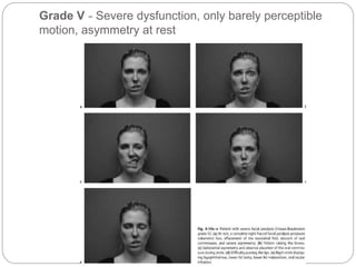Gradual Paralysis Facial paralysis | PPTX