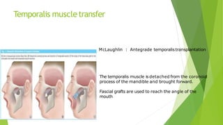 Temporalis muscletransfer
McLaughlin : Antegrade temporalistransplantation
The temporalis muscle is detached from the coronoid
process of the mandible and brought forward.
Fascial grafts are used to reach the angle of the
mouth
 