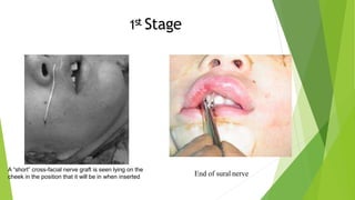 1st Stage
A “short” cross-facial nerve graft is seen lying on the
cheek in the position that it will be in when inserted End of sural nerve
 