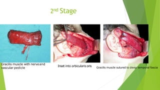 2nd Stage
Gracilis muscle with nerveand
vascular pedicle
Inset into orbicularis oris Gracilis muscle sutured to deep temporal fascia
 