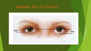 MARGINAL REFLEX DISTANCE
 