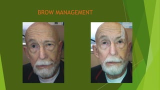 BROW MANAGEMENT
 