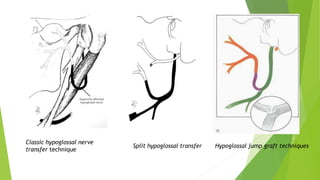 Classic hypoglossal nerve
transfer technique
Split hypoglossal transfer Hypoglossal jump graft techniques
 