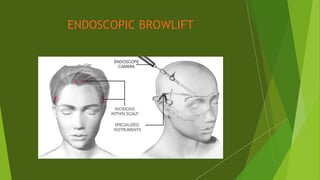 ENDOSCOPIC BROWLIFT
 