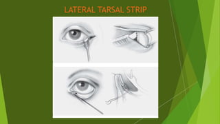 LATERAL TARSAL STRIP
 