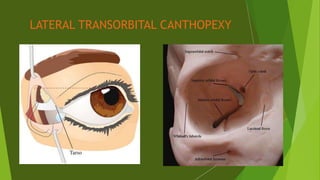 LATERAL TRANSORBITAL CANTHOPEXY
 