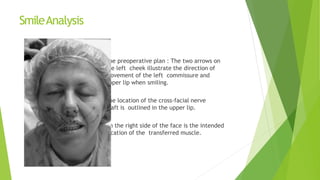 SmileAnalysis
 The preoperative plan : The two arrows on
the left cheek illustrate the direction of
movement of the left commissure and
upper lip when smiling.
 The location of the cross-facial nerve
graft is outlined in the upper lip.
 On the right side of the face is the intended
location of the transferred muscle.
 
