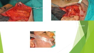 Photo 1: Subdermal dissection to expose SMAS Photo 2: Skeletonization of zygomatic arch
Photo 3: Orientation of Fascia lata
 