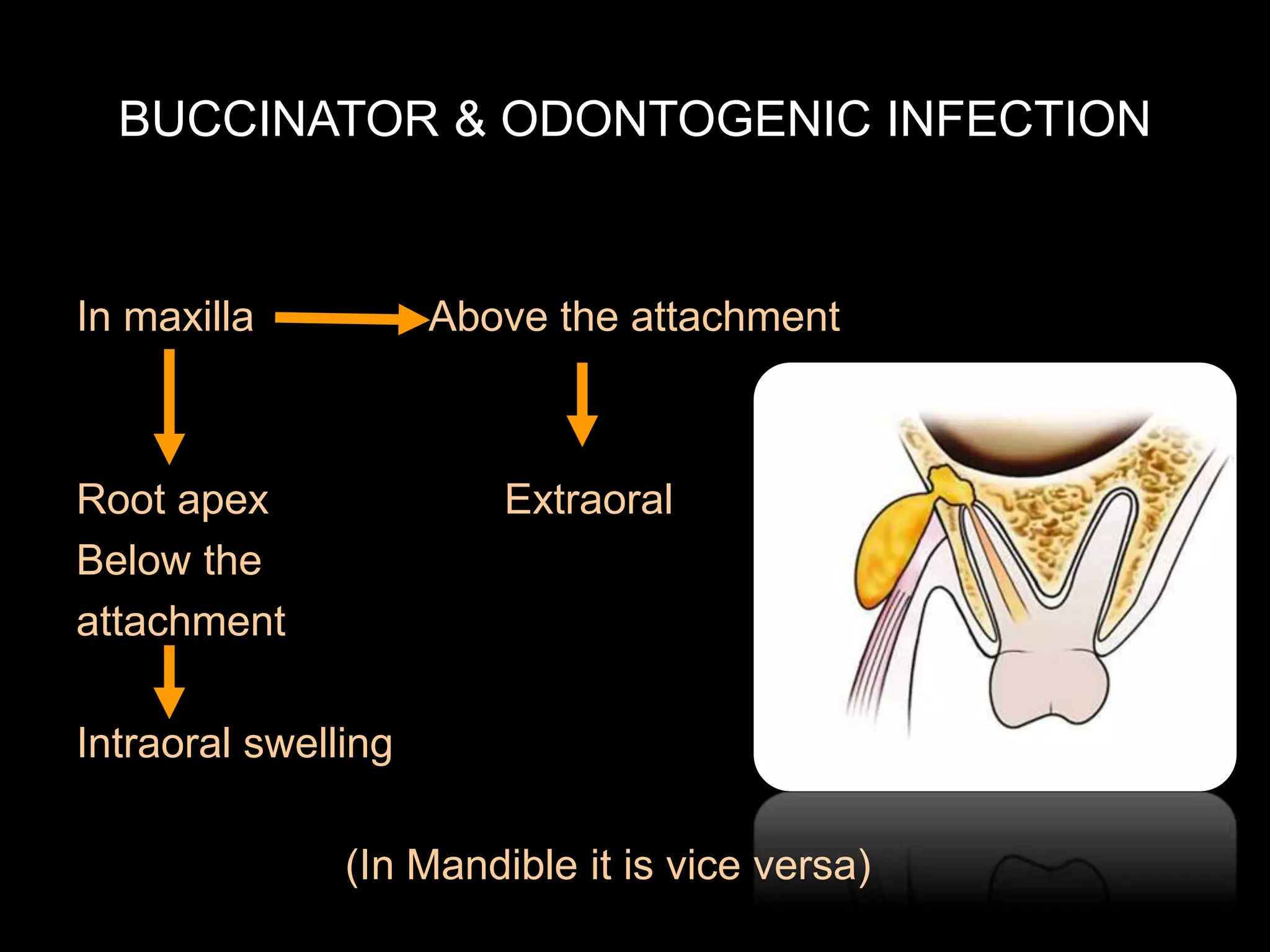 BUCCINATOR & ODONTOGENIC INFECTION 
In maxilla Above the attachment 
Root apex Extraoral 
Below the 
attachment 
Intraoral swelling 
(In Mandible it is vice versa) 
 